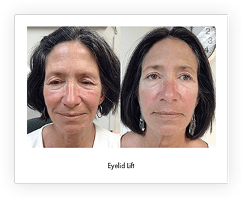 Before and after