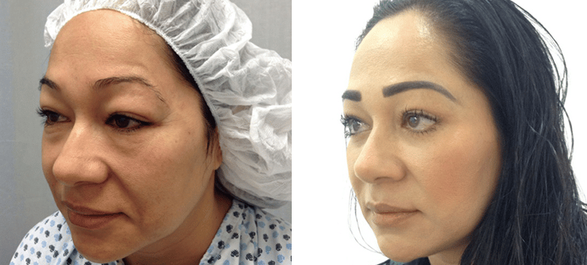 Before & After