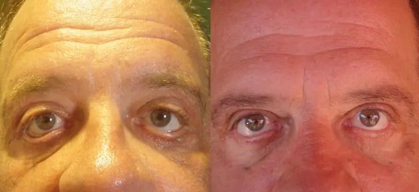 Eyelid Lift Blepharoplasty Guadalajara Mexico Eyelid Lift Blepharoplasty Guadalajara Mexico