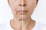 facelift before after
