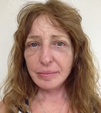 Eyelid Lift