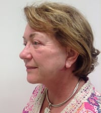 Eyelid Lift