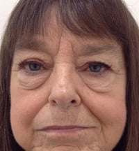 Eyelid Lift