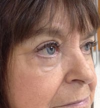 Eyelid Lift