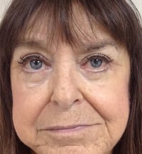 Eyelid Lift