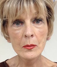 Facelift