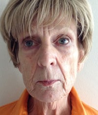 Facelift