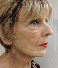 Facelift