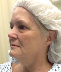Facelift