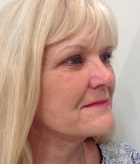 Facelift