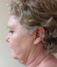 Facelift