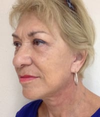 Facelift