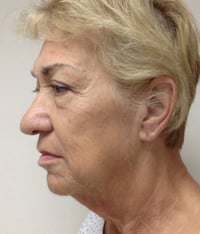 Facelift