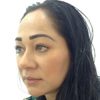 Facial Fat Transfer