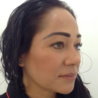 Facial Fat Transfer