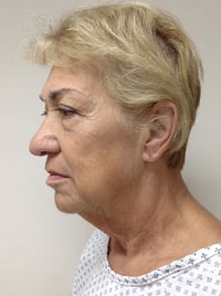 Facelift