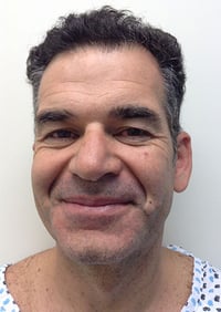 Eyelid Lift