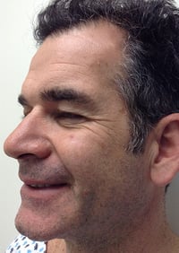 Eyelid Lift