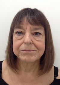 Eyelid Lift