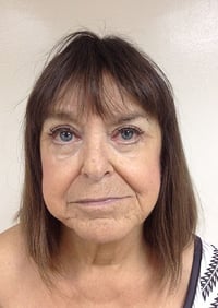 Eyelid Lift