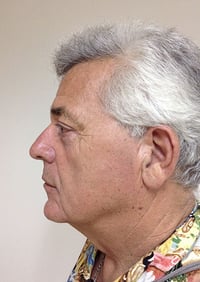 Eyelid Lift