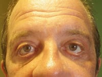 Eyelid Lift