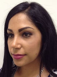 Rhinoplasty