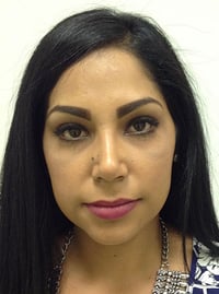 Rhinoplasty