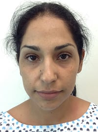 Rhinoplasty