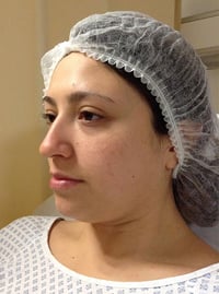 Rhinoplasty