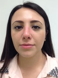 Rhinoplasty