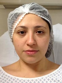 Rhinoplasty