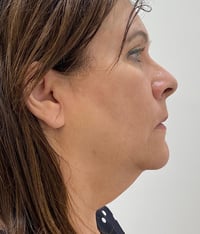 Facelift