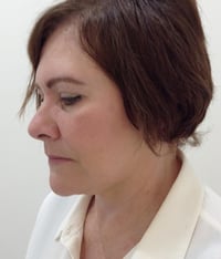 Facelift