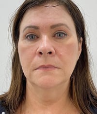 Facelift