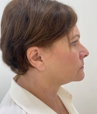 Facelift