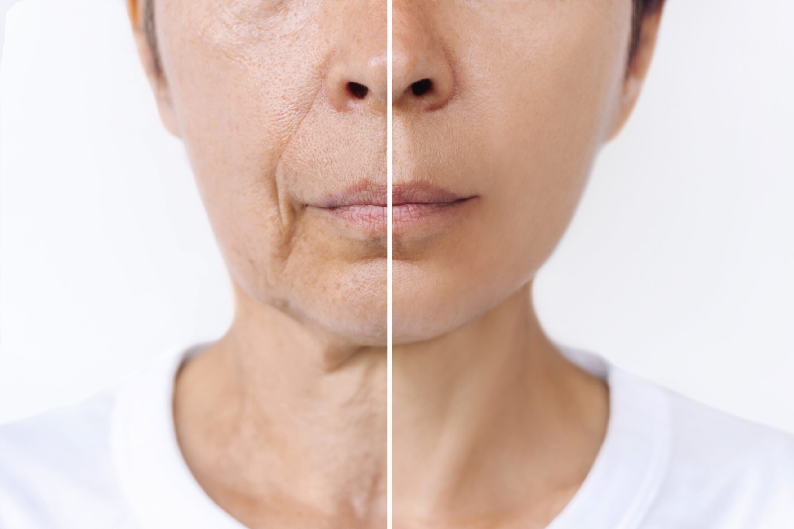 facelift before after