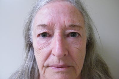 Eyelid Lift