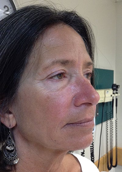 Eyelid Lift