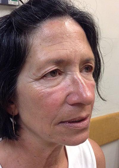 Eyelid Lift