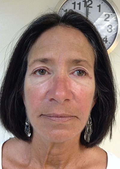 Eyelid Lift