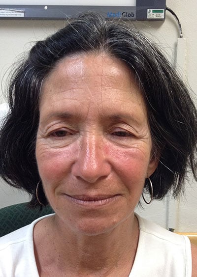 Eyelid Lift