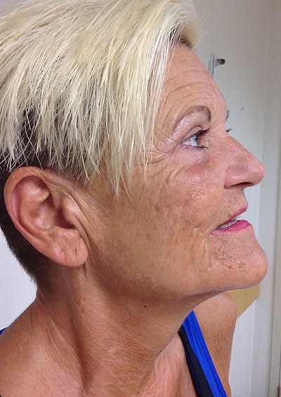 Eyelid Lift
