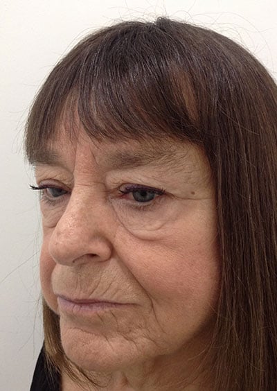 Eyelid Lift