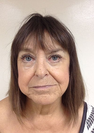 Eyelid Lift