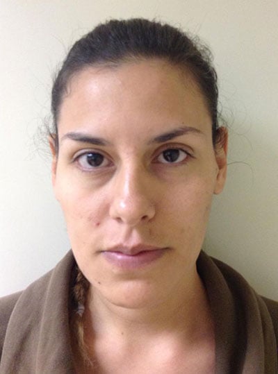 Rhinoplasty