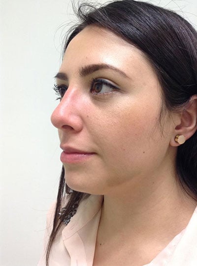 Rhinoplasty