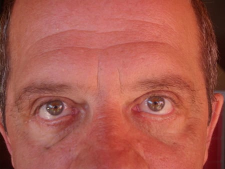 Eyelid Lift