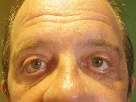 Eyelid Lift