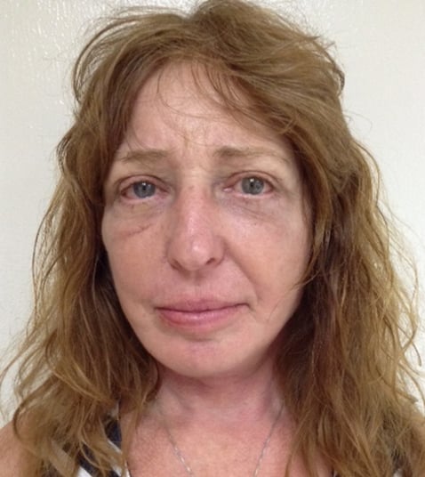 Eyelid Lift